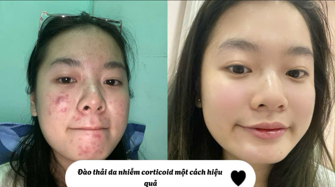 Combo đào thải da nhiễm corticoid WS - Ảnh 2